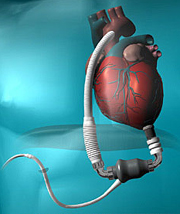 HeartMateII