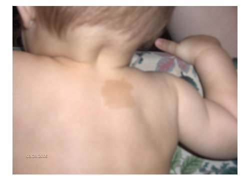 iBaby born with Apple birthmark