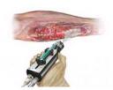 Skin gun shoots Stem Cells to heal wounds