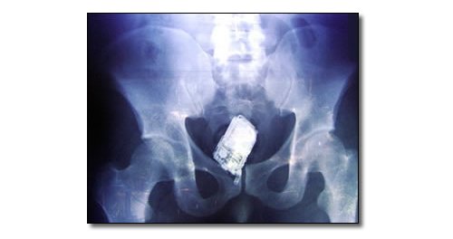 7 prisoners hospitalised, smuggled phones in rectums