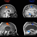 Brain scan shows vegetative patient answering yes or no questions