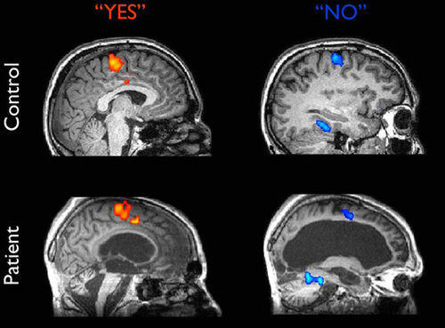 Brain scan shows vegetative patient answering yes or no questions